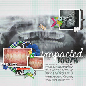 Impacted Tooth